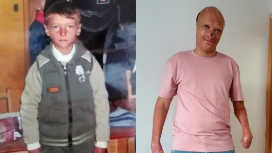 Exemplul de curaj al tânărului mutilat de un incendiu în copilărie. „Nu mă ...